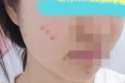 臉上結痂掉了有紅印多久能好