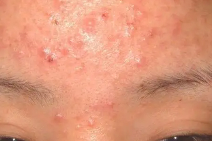眉尾起痘痘怎么辦