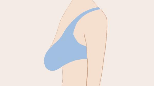 乳房下垂的解決方法是什么