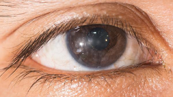 慢性結(jié)膜炎畏光愛流眼淚怎么辦