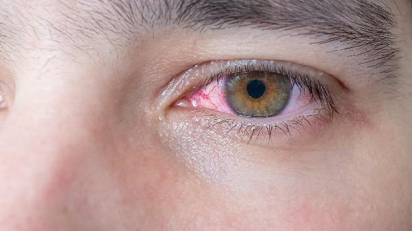 結膜炎一直流眼淚怎么辦