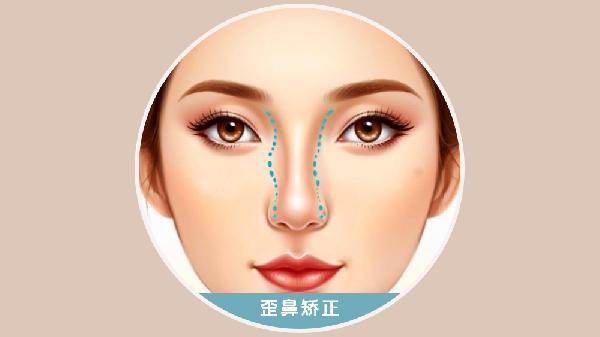 歪鼻矯正價(jià)格是多少