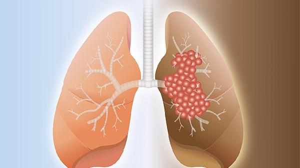 肺部浸润性腺癌1cm大属于早期吗
