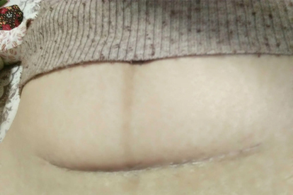 剖腹产三个月内尽量少抱孩子