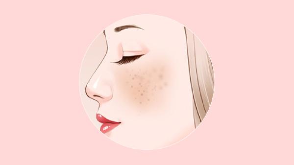 黄褐斑怎样治疗效果好女性