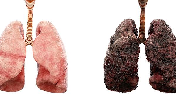 腺样囊性癌属于严重的癌症吗
