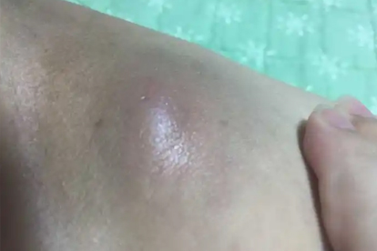 皮脂腺囊腫怎樣治療