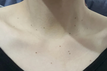 32歲女子查出宮頸癌，提醒女性朋友：感染HPV時(shí)有癥狀，需多觀(guān)察
