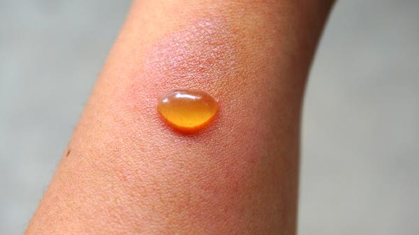 手上長(cháng)了好多小水泡特別癢怎么辦