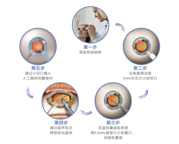 蔡司三焦點(diǎn)納入國采，親民價(jià)格降幅大、性?xún)r(jià)比高