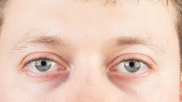 黑眼圈都是睡眠不足引起的吗
