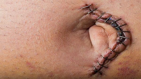 疤痕增生凸起來一塊肉怎么辦