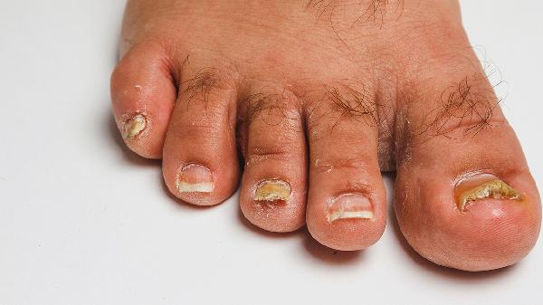 甲溝炎可以用鹽水泡腳嗎