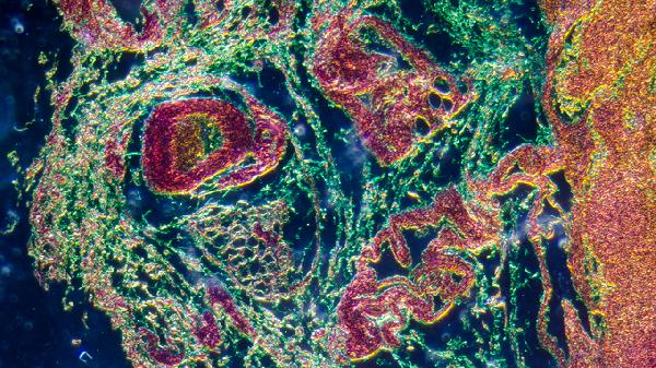 如何區(qū)分病毒和細(xì)菌性咽炎