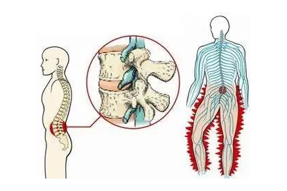 腰椎骨折搬运法需用几人搬运