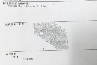 肝癌晚期出现出血还能活多久