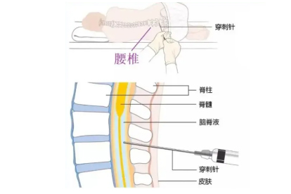 腰间盘突出腰椎坐骨神经疼