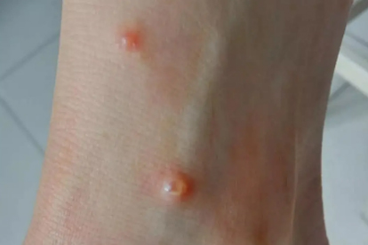 带状性疱疹早期症状