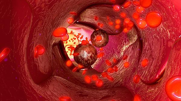 胸腔內腫瘤的術(shù)后護理