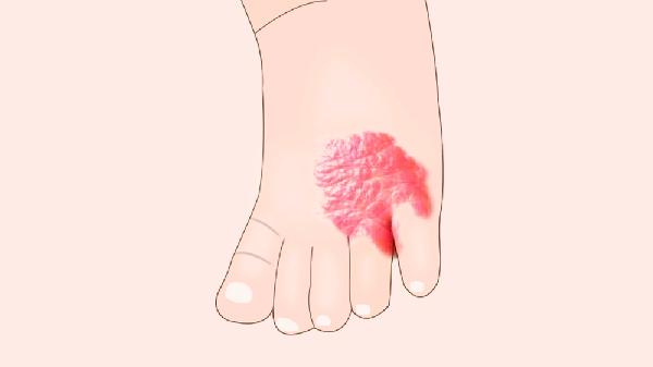 眼眶海綿狀血管瘤