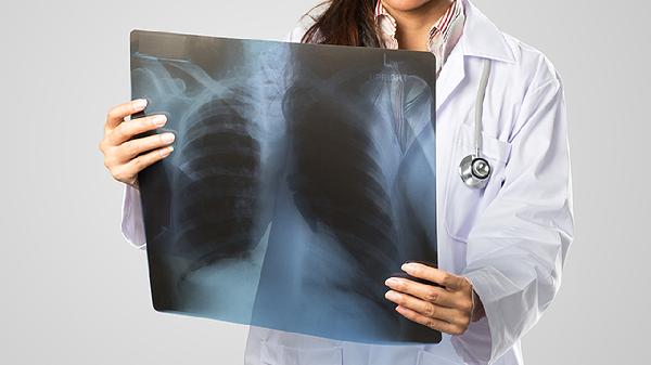肺癌轉移腦腫瘤積水