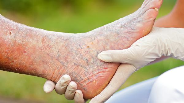 腳氣腳水泡治療方法