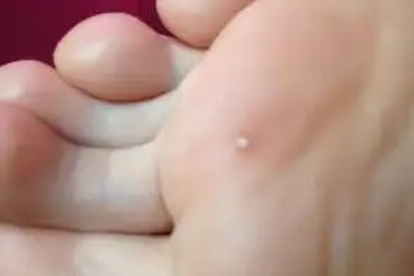 雞眼冷凍后幾天能走路