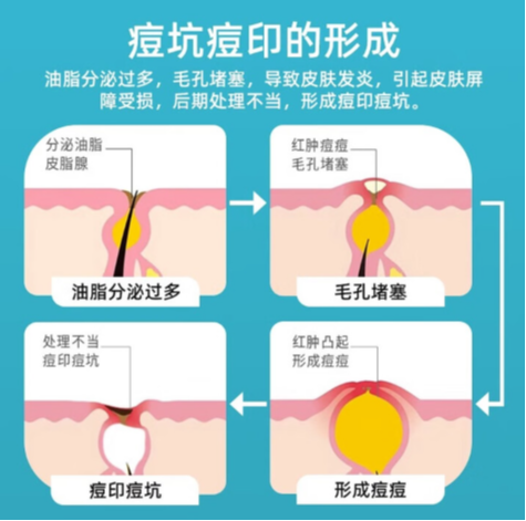 祛痘印用什么好？2025 去痘印品牌选购指南：科学改善 + 高效修护
