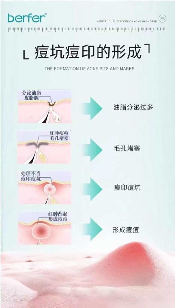 拯救月球臉！2025年公認好用的5款祛痘印藥膏，第一名實(shí)至名歸！