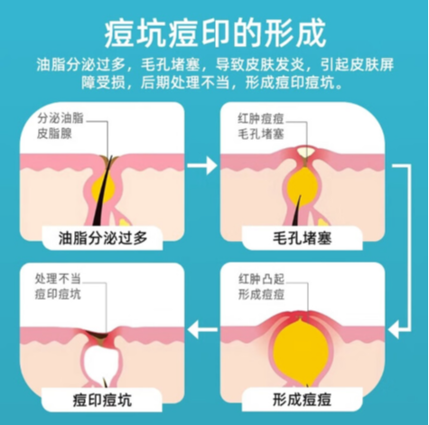 祛痘印用什么好？2025科学淡印清单TOP10！榜首效果太硬核，可以直接抄作业！