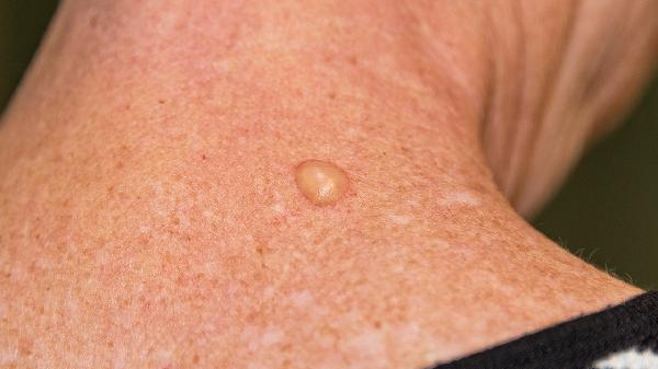 春季皮膚干燥適合吃什么