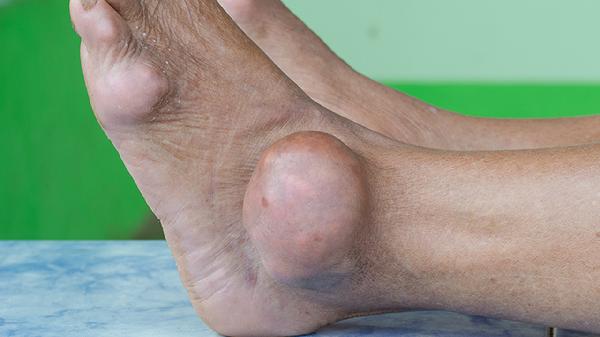 右脚膝盖疼痛怎么治疗