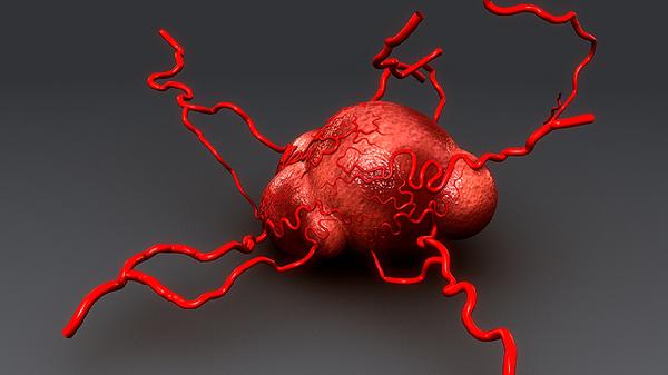 副鼻窦黏膜下囊肿怎么治疗