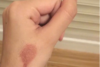 烫伤水泡破了可以用金霉素眼膏吗?