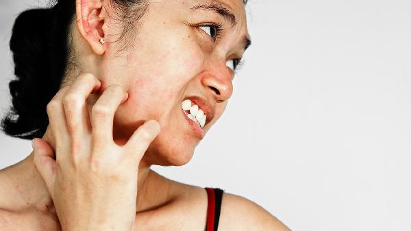 結(jié)節(jié)性癢疹該怎么忌口