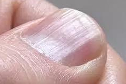 婴儿手指甲根部发黑怎么回事