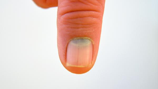 大拇指甲上有豎紋是什么原因