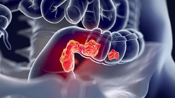 什么是先天性腸道畸形病變