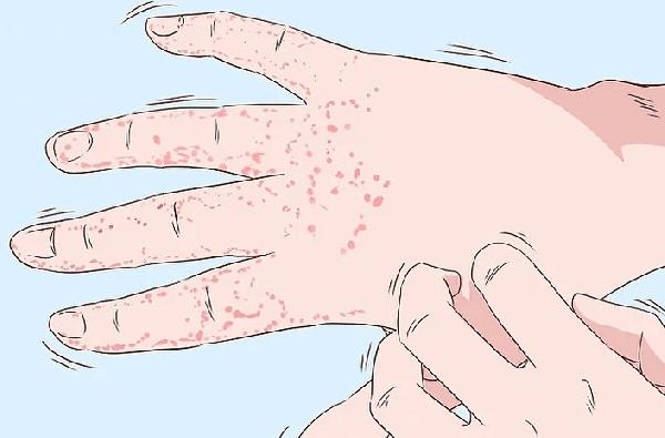 梅毒患者應(yīng)遵循的注意事項