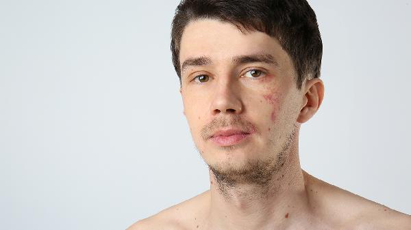 激光去胎記會影響皮膚嗎