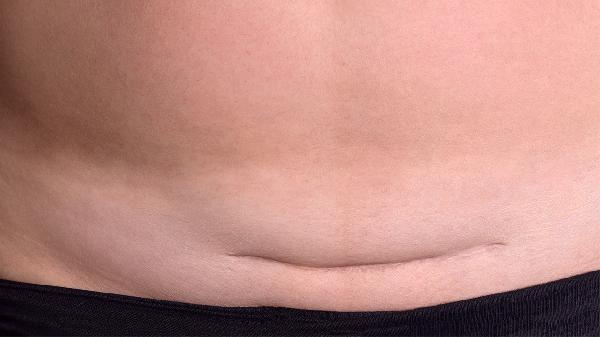 產(chǎn)婦剖腹產(chǎn)手術后的注意事項有哪些