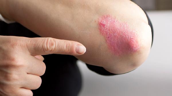 外陰部牛皮癬的誘發(fā)因素有哪些