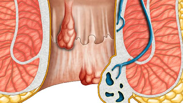 血友病注意哪些能活得長