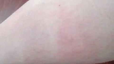 過敏性濕疹有六個特點你屬于哪個