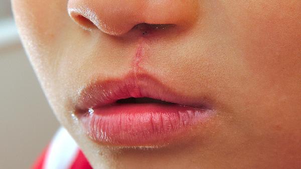 唇腭裂修復(fù)術(shù)前的注意事項是什么