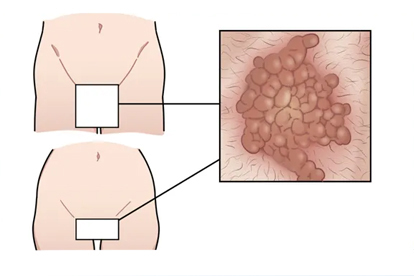 尖銳濕疣為什么要多次治療