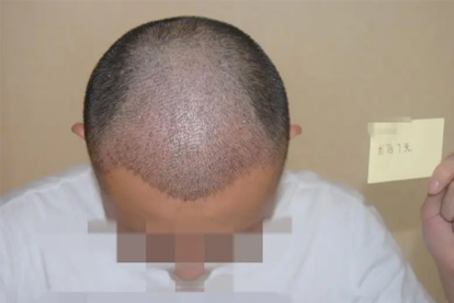 植發(fā)效果好嗎