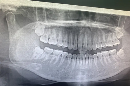 拔掉智齿应该注意些什么