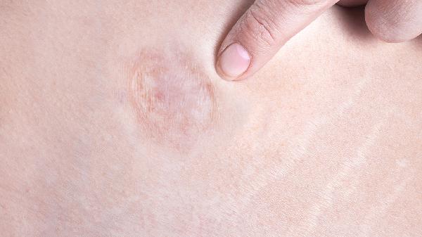 瘢痕移植術(shù)應注意什么