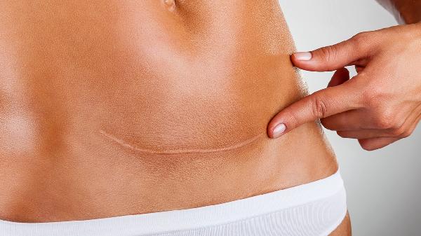 剖腹產(chǎn)后坐月子可吃哪些食物